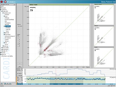 Systém pro dlouhodobou monitoraci srdeční činnosti  - Holter EKG Cardiolight - modul pro analýzu fibrilace síní