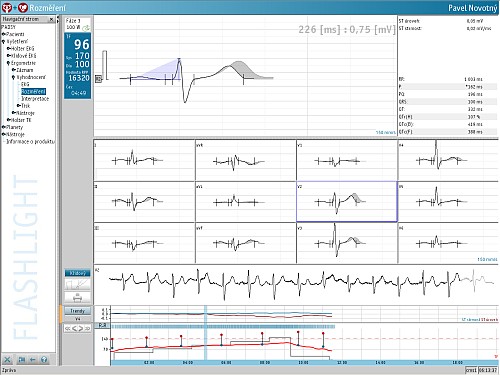 Ergometrický systém FLASHLIGHT ERGO - přehledné vyhodnocení EKG záznamu